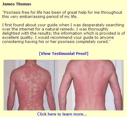 Healing Psoriasis: The Non-Drug Solution